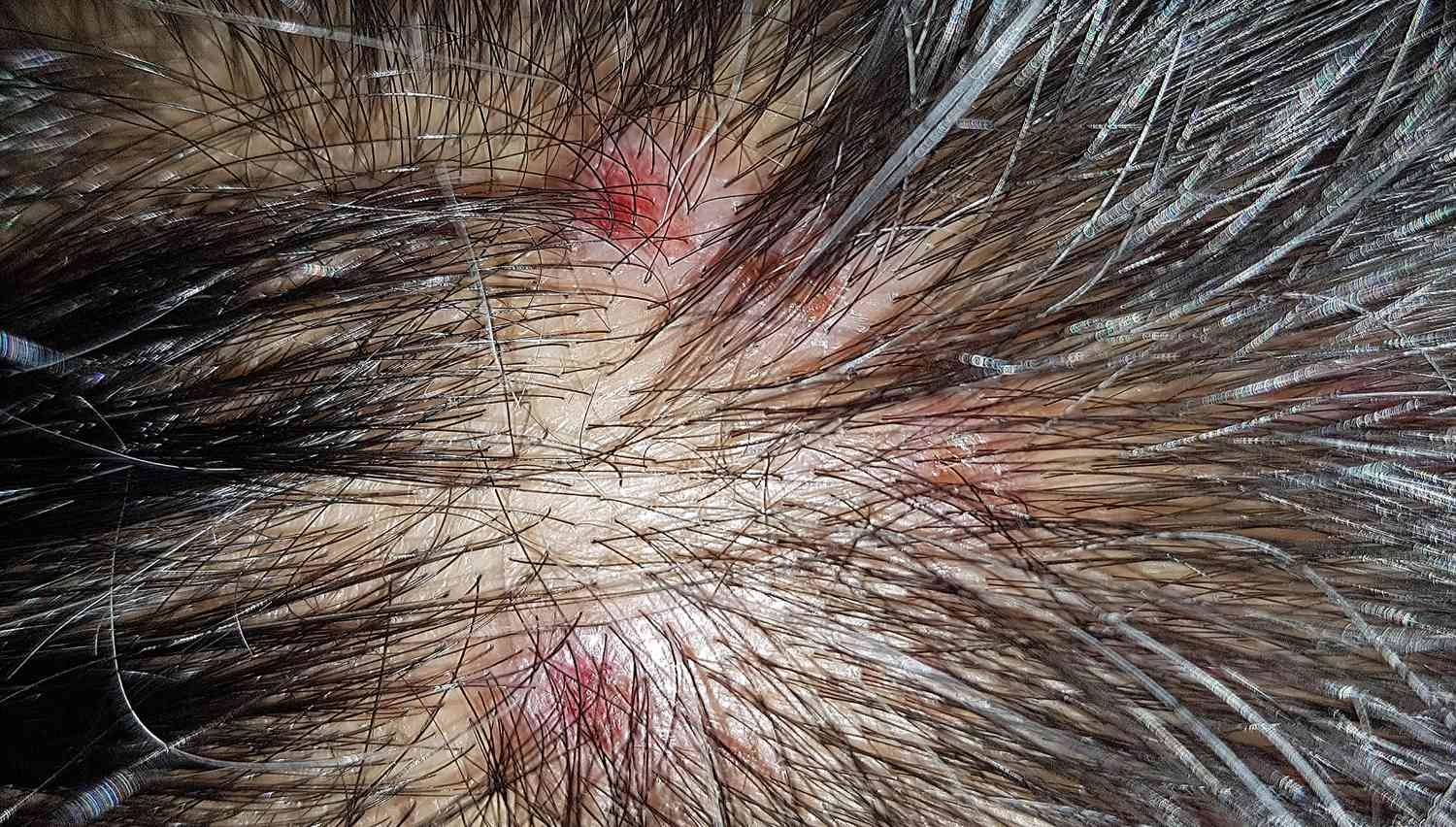 Folliculitis