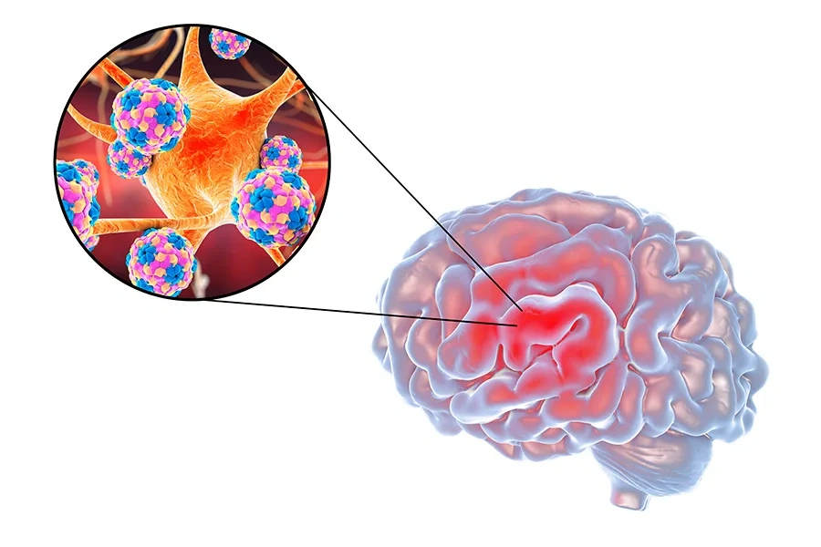 encephalitis