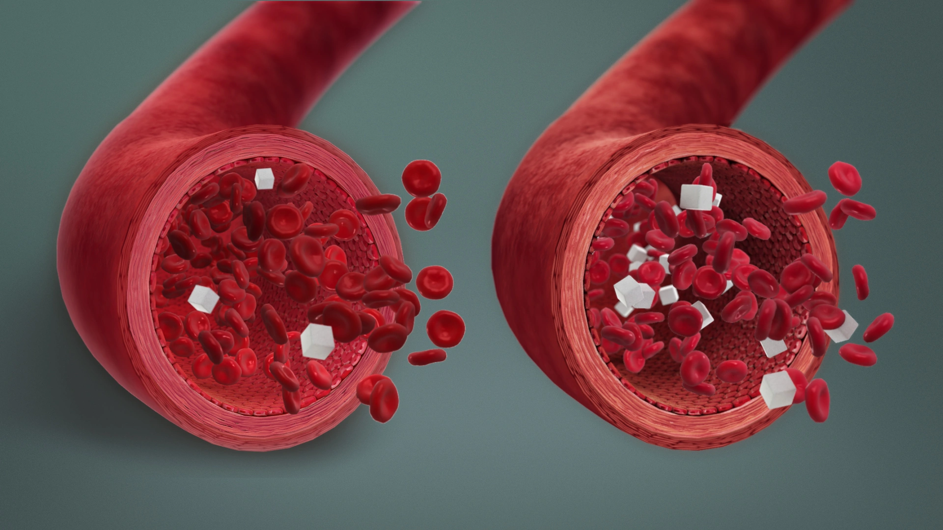 Diabetic Hypoglycemia