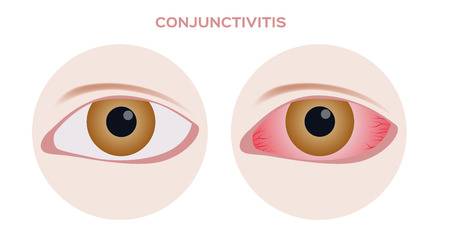 conjunctivitis-pink-inflammation-eye