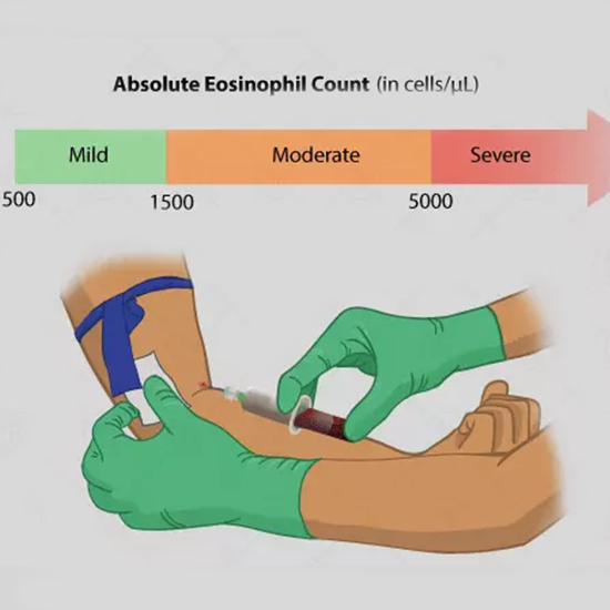 Absolute Eosinophil Count (AEC) Test PrognoHealth Corporate Health