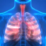 Chronic obstructive pulmonary disease (COPD)