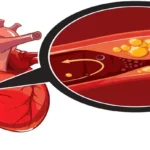 Coronary heart disease