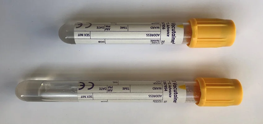 ACE (angiotensin-converting enzyme) Test