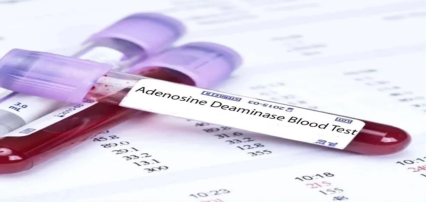 Adenosine Deaminase (ADA) Test