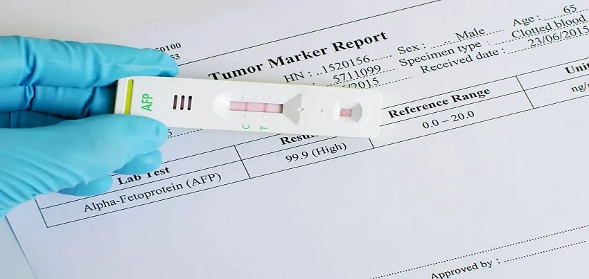 Alpha-Fetoprotein (AFP) Test