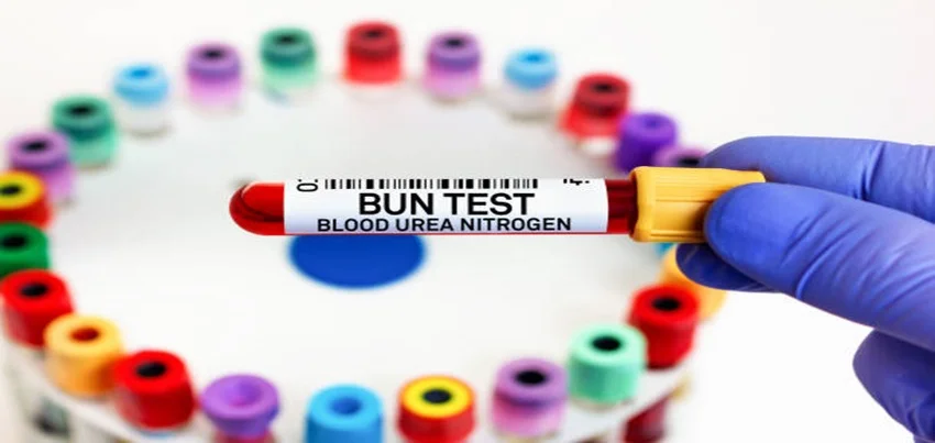 Blood Urea Nitrogen (BUN) Test