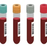 Blood sugar random Test