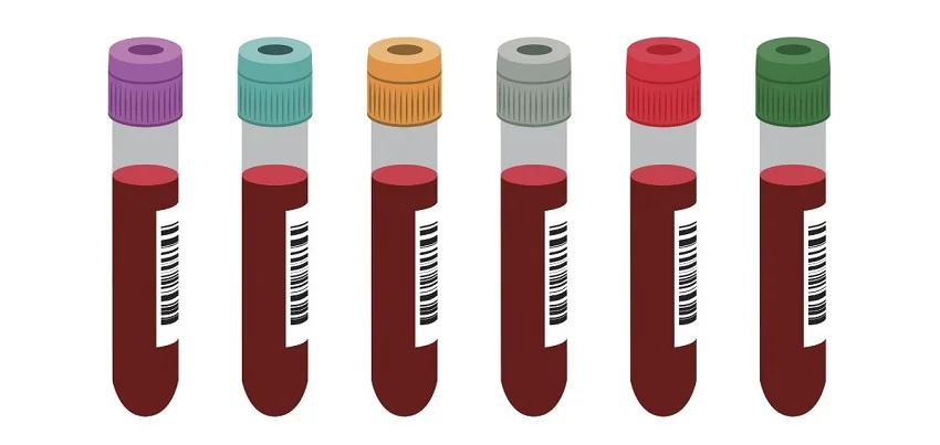 Blood sugar random Test