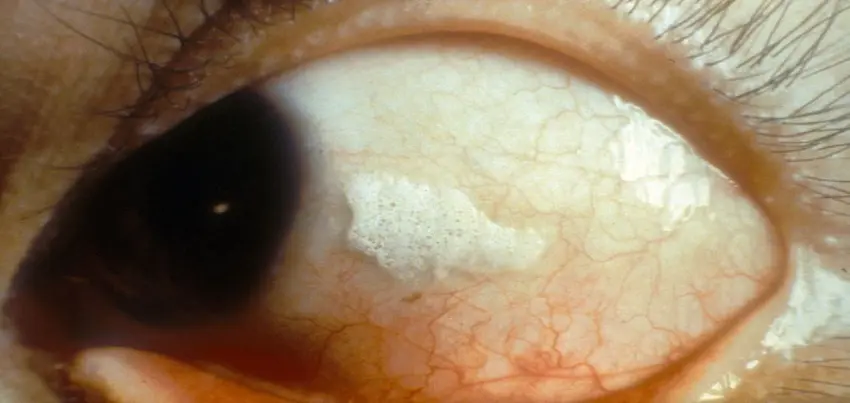 Xerophthalmia