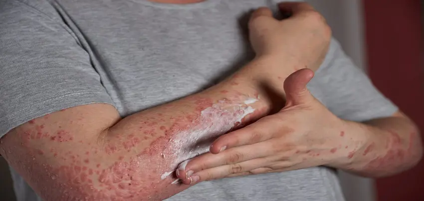 Psoriasis