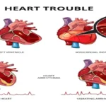 Myocardial