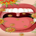 Mouth ulcers