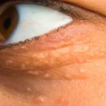 Xanthelasma