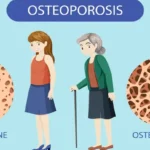 Osteoporosis