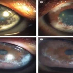 Spheroidal Degeneration