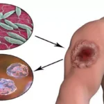 Leishmaniasis