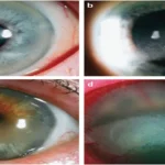 Band-shaped keratopathy