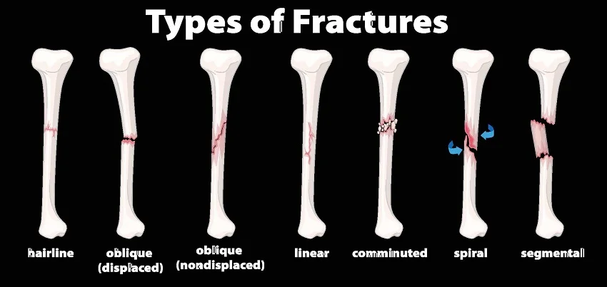 Bone fracture