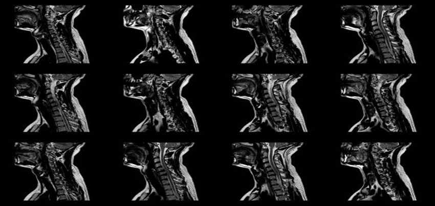 CT Scan Spiral Thoracic Spine