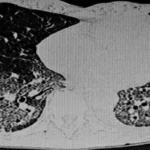 CT scan of the thorax