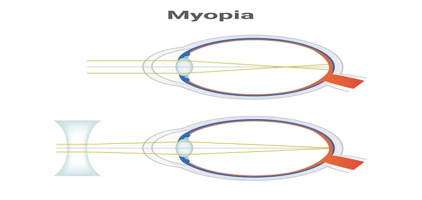 Myopia