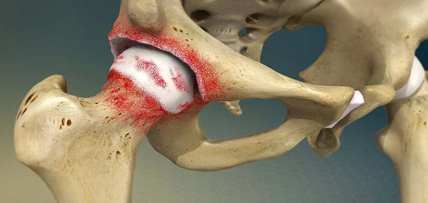 Osteoarthritis (OA)