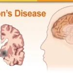 Parkinson's disease (PD)