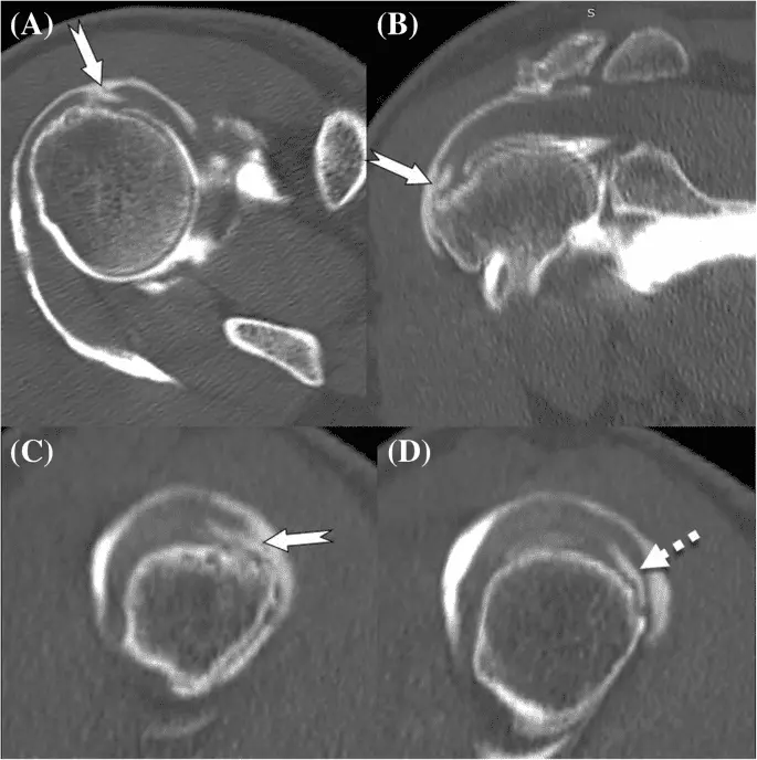 CT scan spiral joint / CT arthrogram