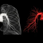 Angio Pulmonary