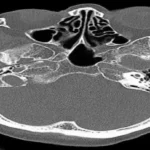 CT Scan of the Temporal Bone or Mastoid Bone