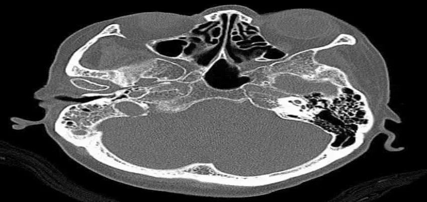 CT Scan of the Temporal Bone or Mastoid Bone
