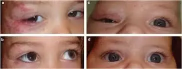 Congenital capillary haemangioma of the eyelid
