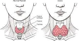 Goitre1