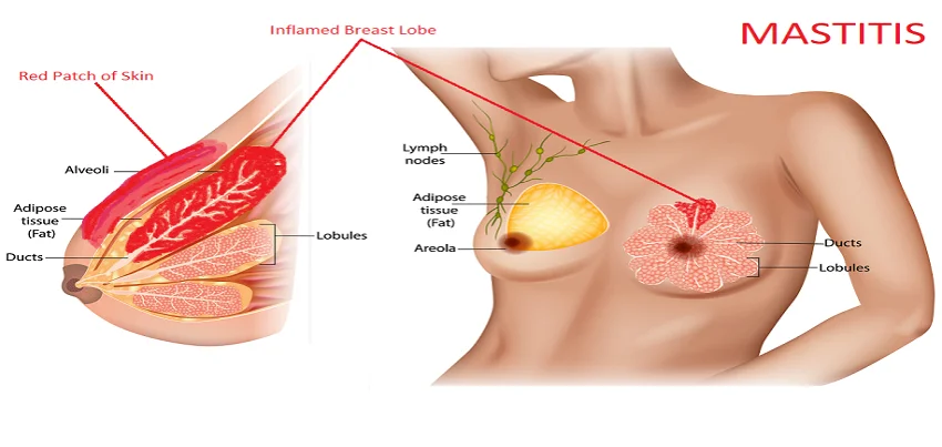 Mastitis