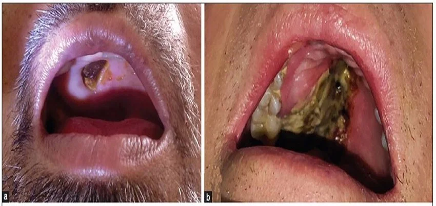 Mucormycosis