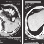 CT Scan Spiral Pelvis