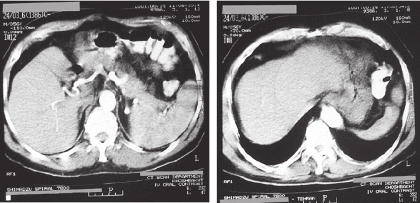 CT Scan Spiral Pelvis