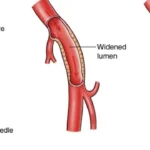 Angio Pulmonary