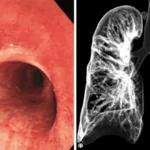 Virtual Bronchoscopy