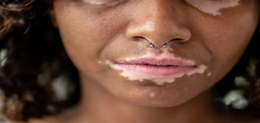 Vitiligo