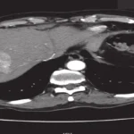 CT Scan of the Abdomen Triphasic Liver