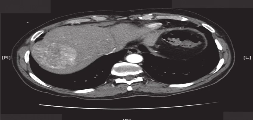 CT Scan of the Abdomen Triphasic Liver