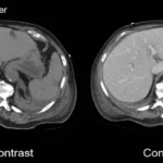 CT scan of the abdomen