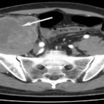 CT scan of the pelvis