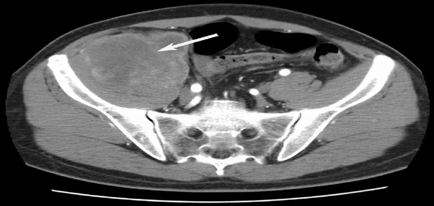 CT scan of the pelvis