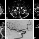 CT scan spiral brain + angio