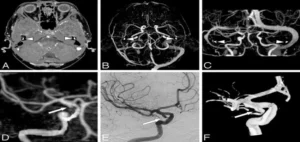 CT scan spiral brain + angio