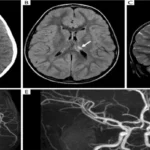 MRI Angiograpy Of Brain or MRA of Brain