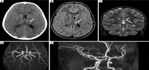 MRI Brain + Angiography